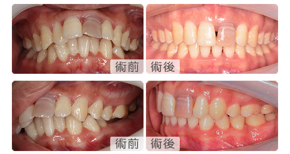 徐先生死髓牙深覆合矫正案例