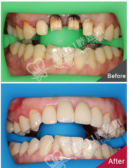东莞邓小姐门牙烤瓷牙换全瓷牙修复案例