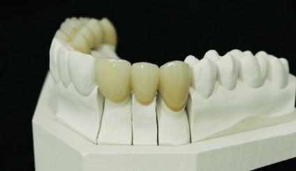 全瓷牙与烤瓷牙能修复牙缺失