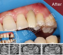东莞刘先生前牙种植牙案例