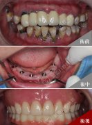 无牙颌种植及修复案例