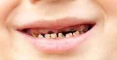 为何越来越多的孩子满口“黑牙”?