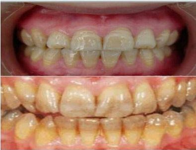 四环素牙的病因