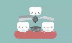 拔牙后多久可以进行种牙？